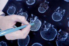 大脑镰旁脑膜瘤是什么？