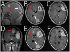双丘脑胶质瘤可能与单侧