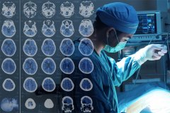 脑膜瘤医治分析报告和存在的问题