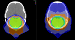 双丘脑胶质瘤可能与单侧