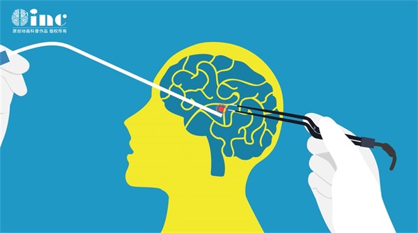 大脑镰旁脑膜瘤多大算大？多大影响听力？